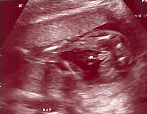09-2008Sept03c - It's A Boy!